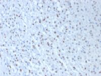 FFPE human mesothelioma sections stained with 100 ul anti-Wilms Tumor 1 (clone WT1/857 + 6F-H2) at 1:50. HIER epitope retrieval prior to staining was performed in 10mM Citrate, pH 6.0.